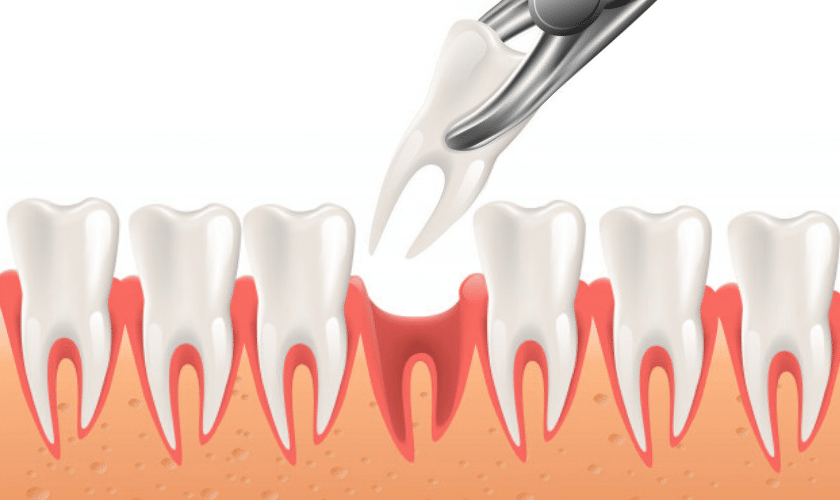tooth extraction