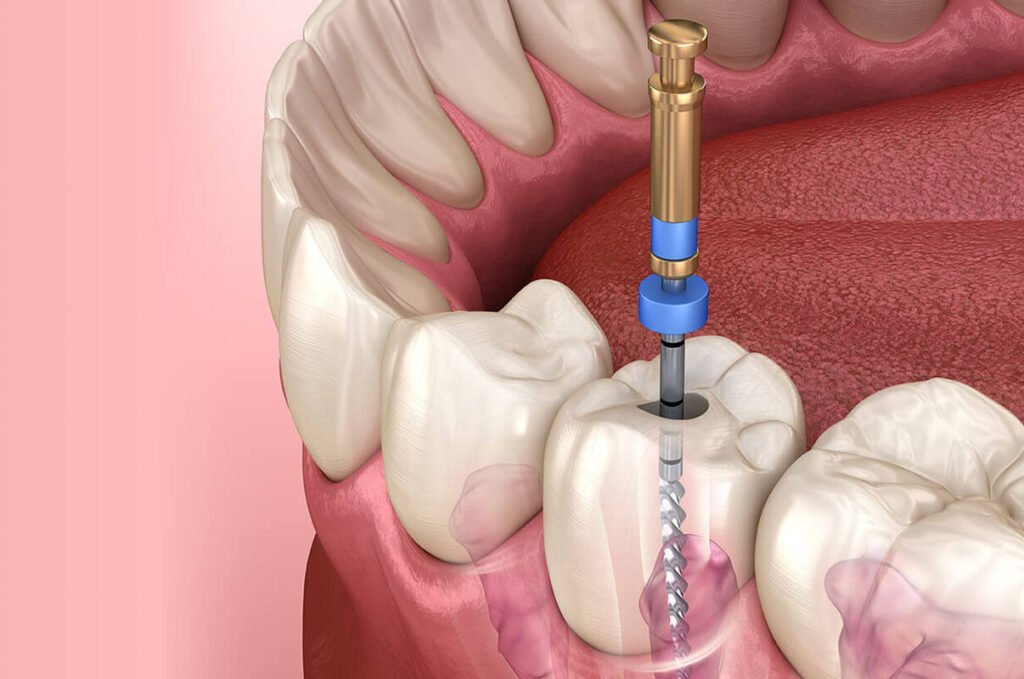 root canal treatment