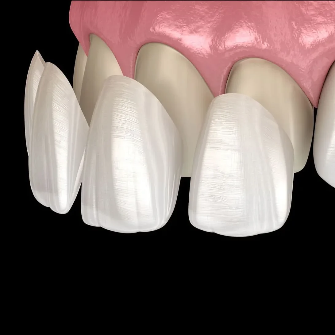 e max veneers