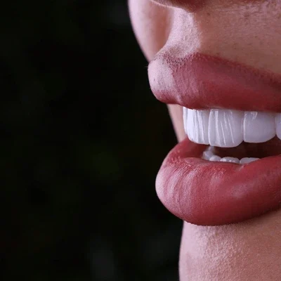 hollywood smile