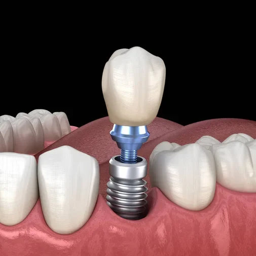 implant