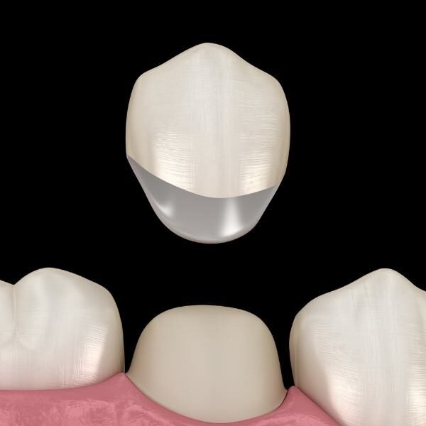 porcelain crown