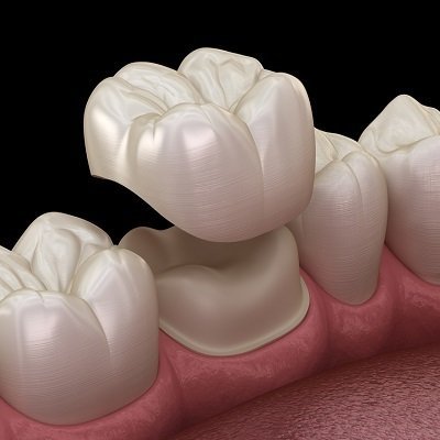 zirconium crown