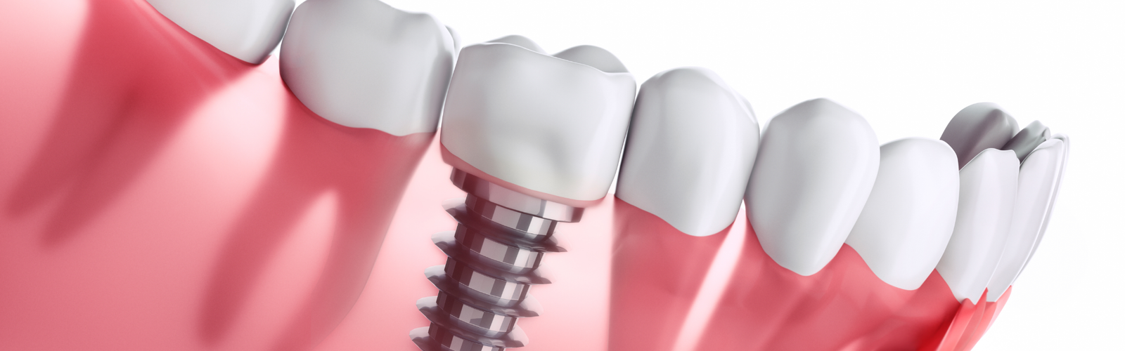 implant banner