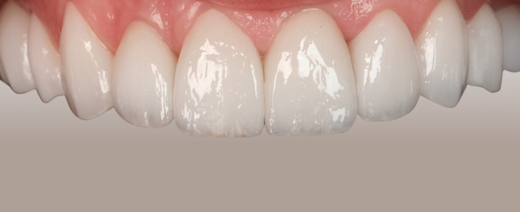 zirconia crown